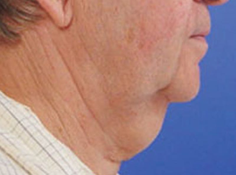 Neck Lift Before & After Gallery - Patient 794169 - Image 3
