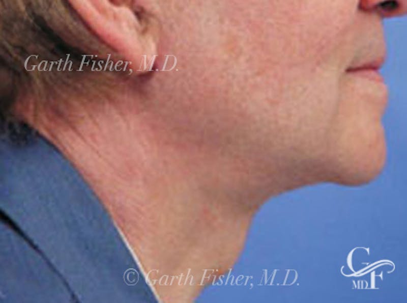 Neck Lift Before & After Gallery - Patient 794169 - Image 4