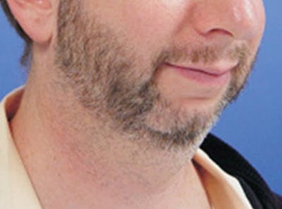 Neck Lift Before & After Gallery - Patient 191012 - Image 1