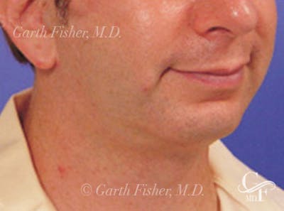 Neck Lift Before & After Gallery - Patient 191012 - Image 2