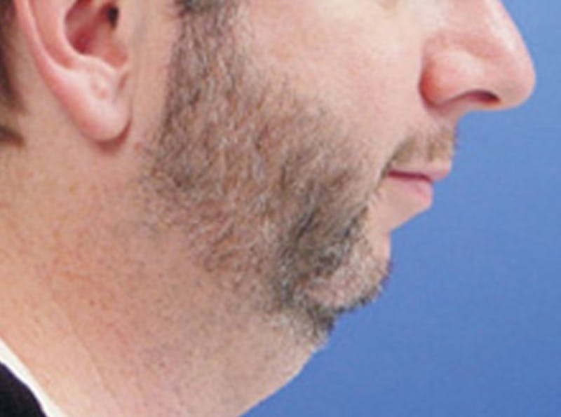 Neck Lift Before & After Gallery - Patient 191012 - Image 3