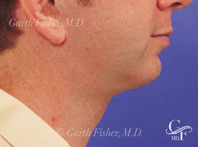 Neck Lift Before & After Gallery - Patient 191012 - Image 4