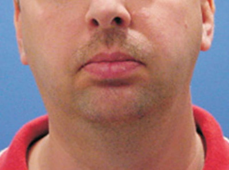 Neck Lift Before & After Gallery - Patient 120396 - Image 1