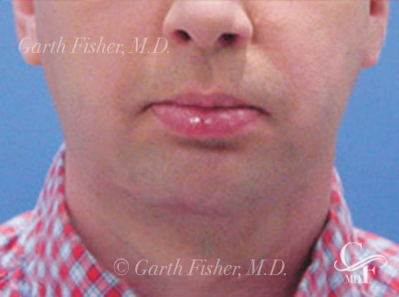Neck Lift Before & After Gallery - Patient 120396 - Image 2