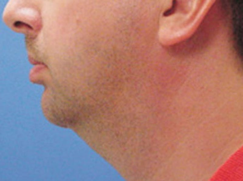 Neck Lift Before & After Gallery - Patient 120396 - Image 3