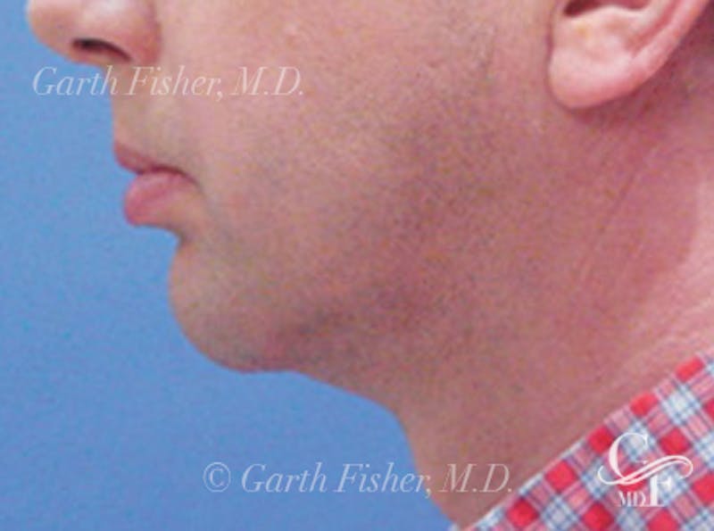 Neck Lift Before & After Gallery - Patient 120396 - Image 4