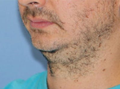 Neck Lift Before & After Gallery - Patient 403512 - Image 1
