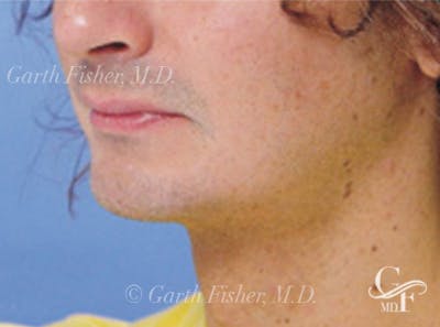 Neck Lift Before & After Gallery - Patient 403512 - Image 2