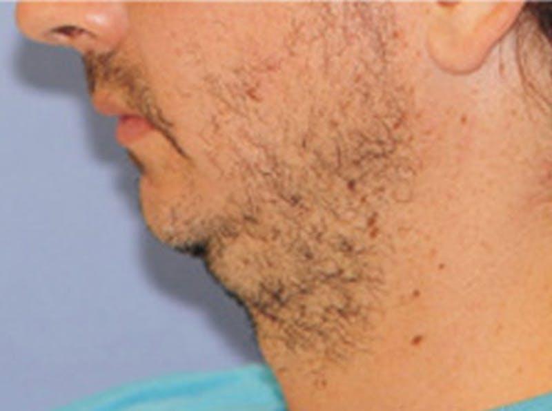 Neck Lift Before & After Gallery - Patient 403512 - Image 3