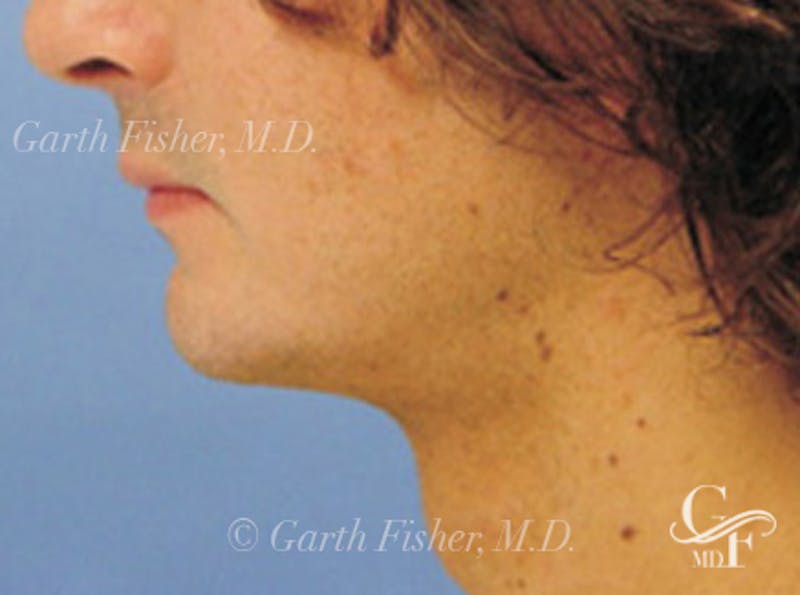 Neck Lift Before & After Gallery - Patient 403512 - Image 4