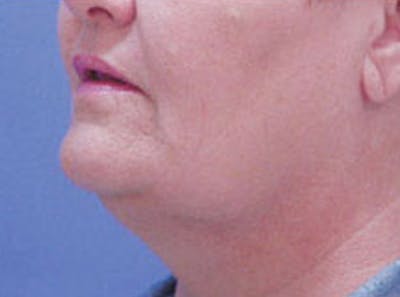 Neck Lift Before & After Gallery - Patient 344655 - Image 1