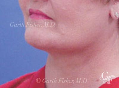 Neck Lift Before & After Gallery - Patient 344655 - Image 2