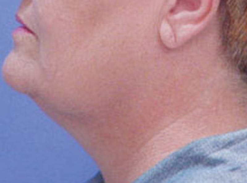 Neck Lift Before & After Gallery - Patient 344655 - Image 3