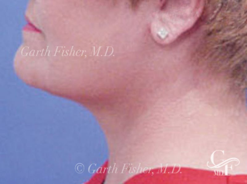 Neck Lift Before & After Gallery - Patient 344655 - Image 4