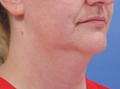 Neck Lift Before & After Gallery - Patient 110223 - Image 1