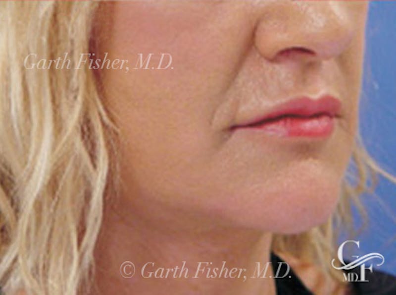 Neck Lift Before & After Gallery - Patient 110223 - Image 2