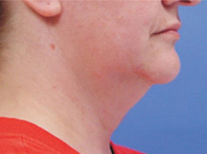 Neck Lift Before & After Gallery - Patient 110223 - Image 3