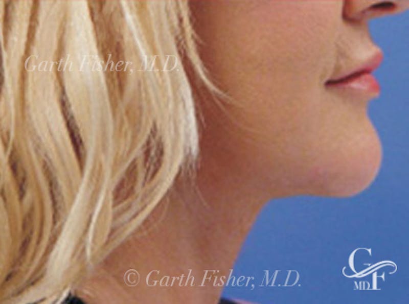 Neck Lift Before & After Gallery - Patient 110223 - Image 4