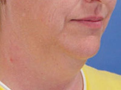 Neck Lift Before & After Gallery - Patient 326909 - Image 1