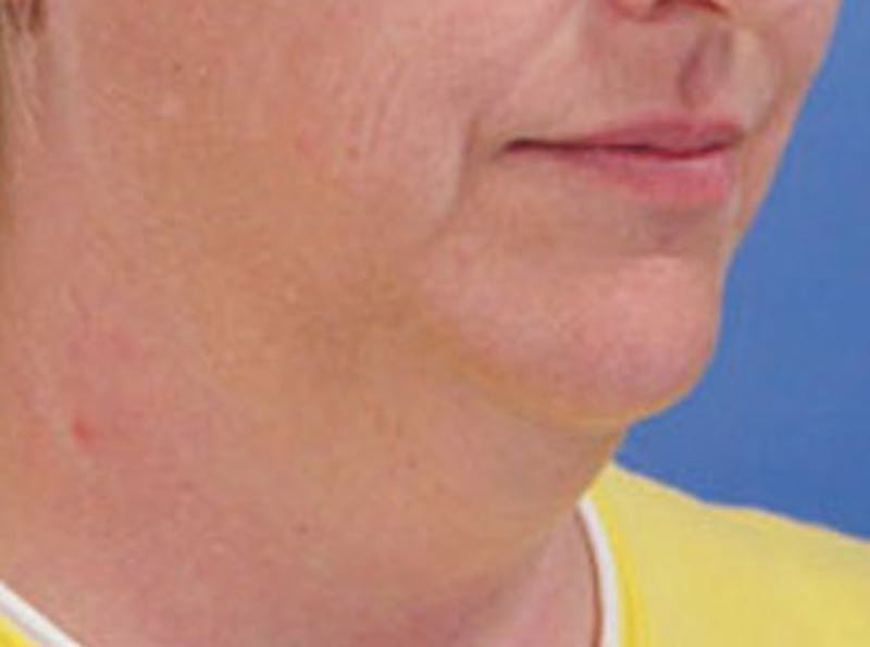 Neck Lift Before & After Gallery - Patient 326909 - Image 1