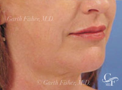 Neck Lift Before & After Gallery - Patient 326909 - Image 2