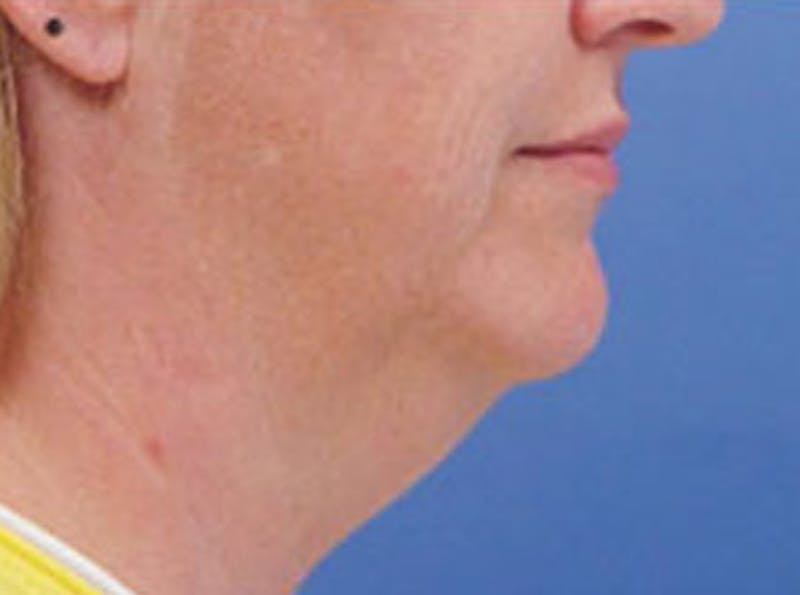 Neck Lift Before & After Gallery - Patient 326909 - Image 3