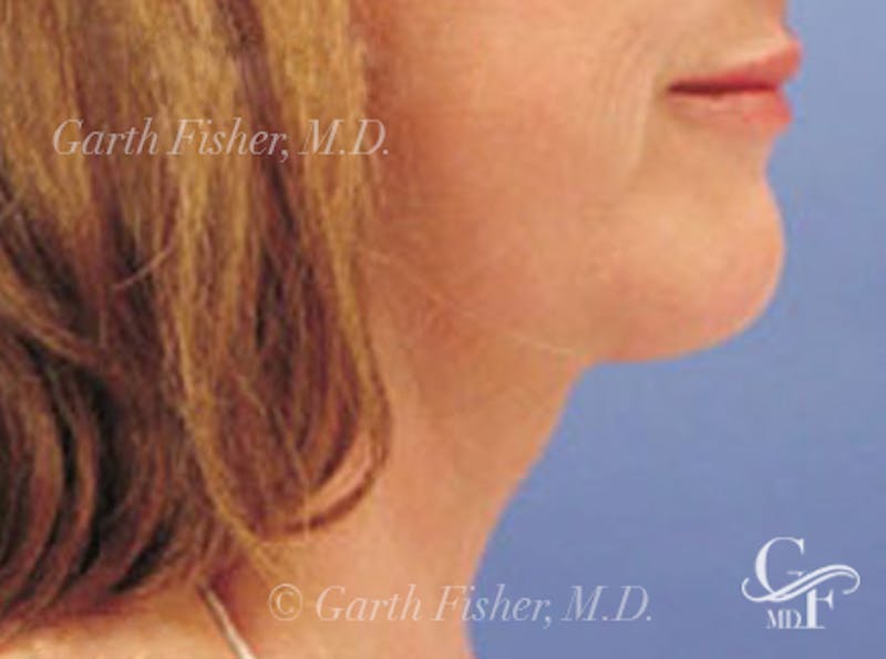 Neck Lift Before & After Gallery - Patient 326909 - Image 4