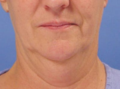 Neck Lift Before & After Gallery - Patient 270672 - Image 1