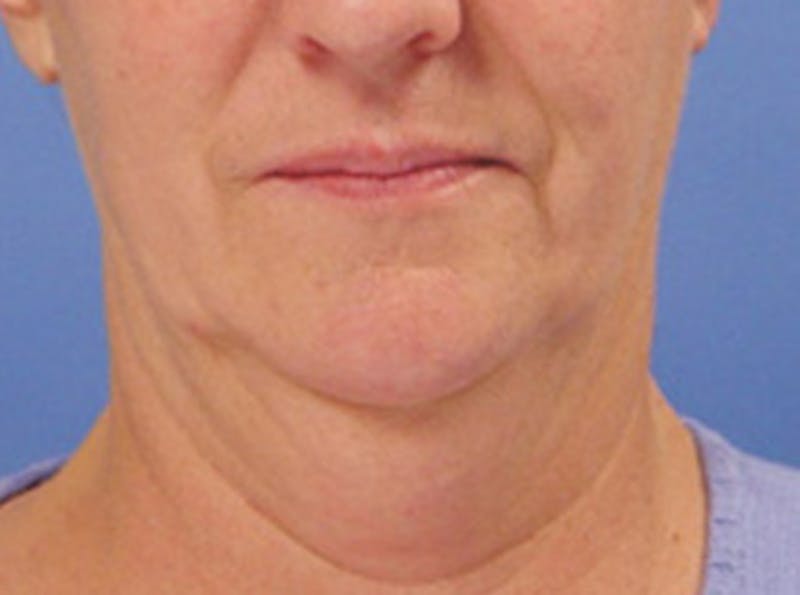 Neck Lift Before & After Gallery - Patient 270672 - Image 1