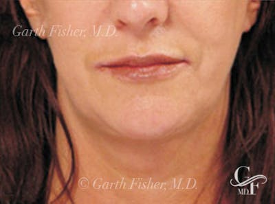 Neck Lift Before & After Gallery - Patient 270672 - Image 2