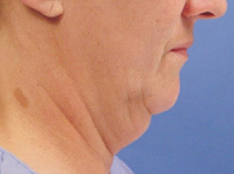 Neck Lift Before & After Gallery - Patient 270672 - Image 3