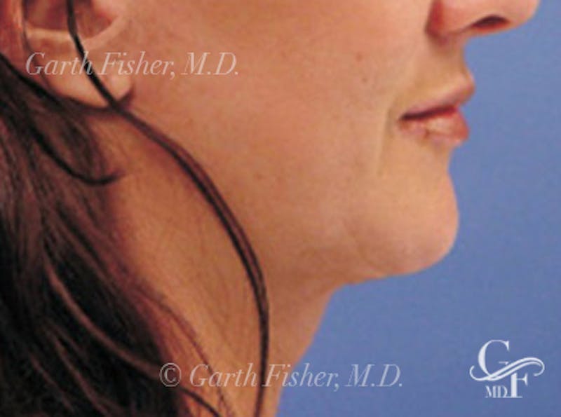 Neck Lift Before & After Gallery - Patient 270672 - Image 4