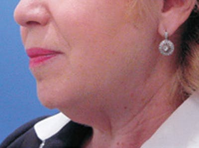Neck Lift Before & After Gallery - Patient 318796 - Image 1
