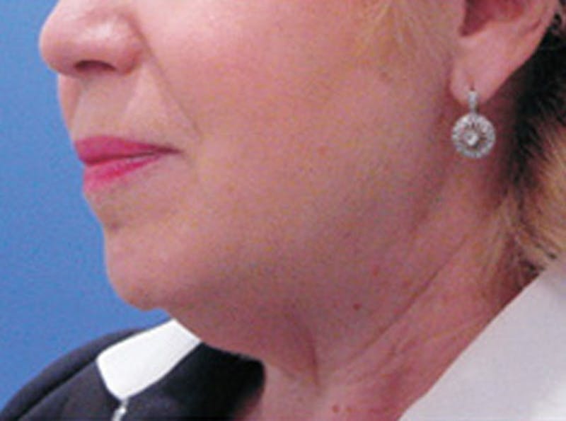 Neck Lift Before & After Gallery - Patient 318796 - Image 1
