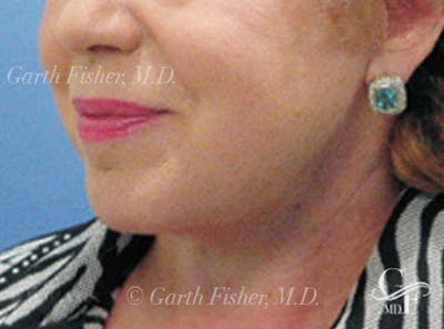 Neck Lift Before & After Gallery - Patient 318796 - Image 2