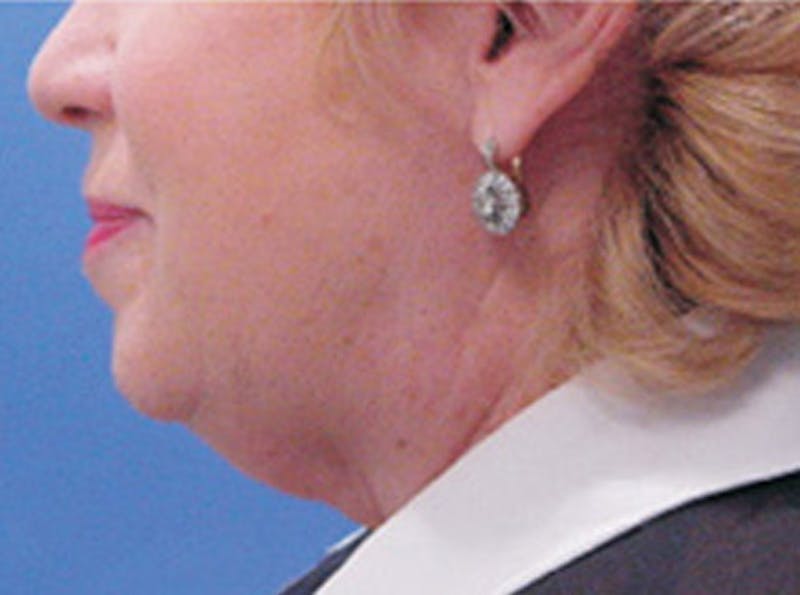 Neck Lift Before & After Gallery - Patient 318796 - Image 3