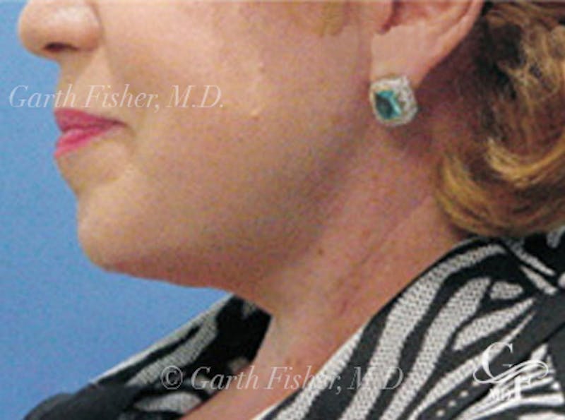 Neck Lift Before & After Gallery - Patient 318796 - Image 4