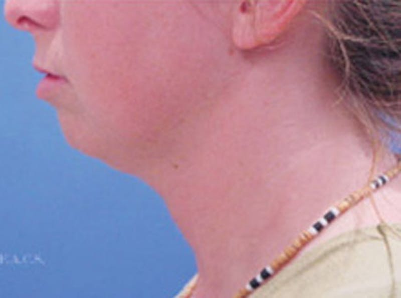 Neck Lift Before & After Gallery - Patient 153220 - Image 1
