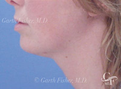Neck Lift Before & After Gallery - Patient 153220 - Image 2