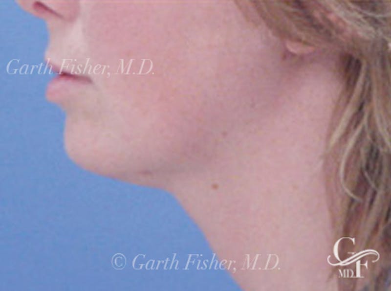 Neck Lift Before & After Gallery - Patient 153220 - Image 2
