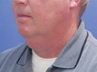 Neck Lift Before & After Gallery - Patient 343619 - Image 1