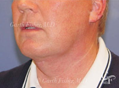 Neck Lift Before & After Gallery - Patient 343619 - Image 2