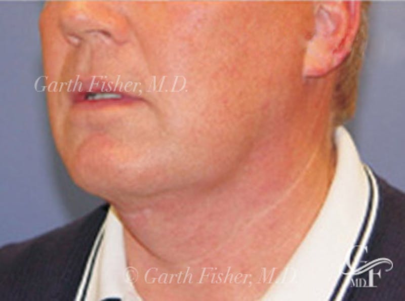 Neck Lift Before & After Gallery - Patient 343619 - Image 2