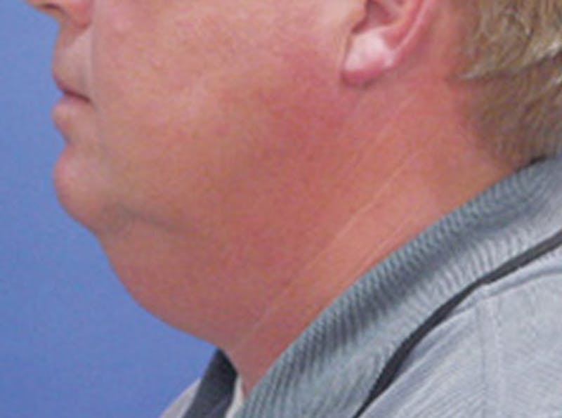 Neck Lift Before & After Gallery - Patient 343619 - Image 3