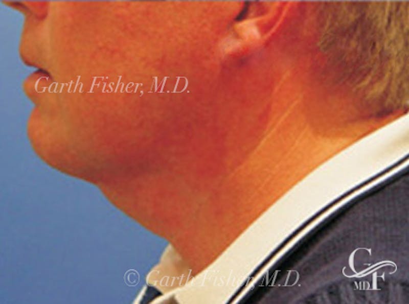 Neck Lift Before & After Gallery - Patient 343619 - Image 4