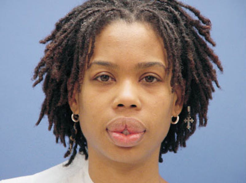 Lip Augmentation Before & After Gallery - Patient 665016 - Image 1