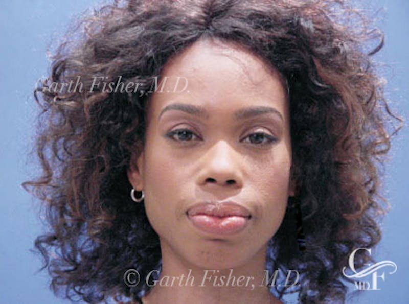 Lip Augmentation Before & After Gallery - Patient 665016 - Image 2