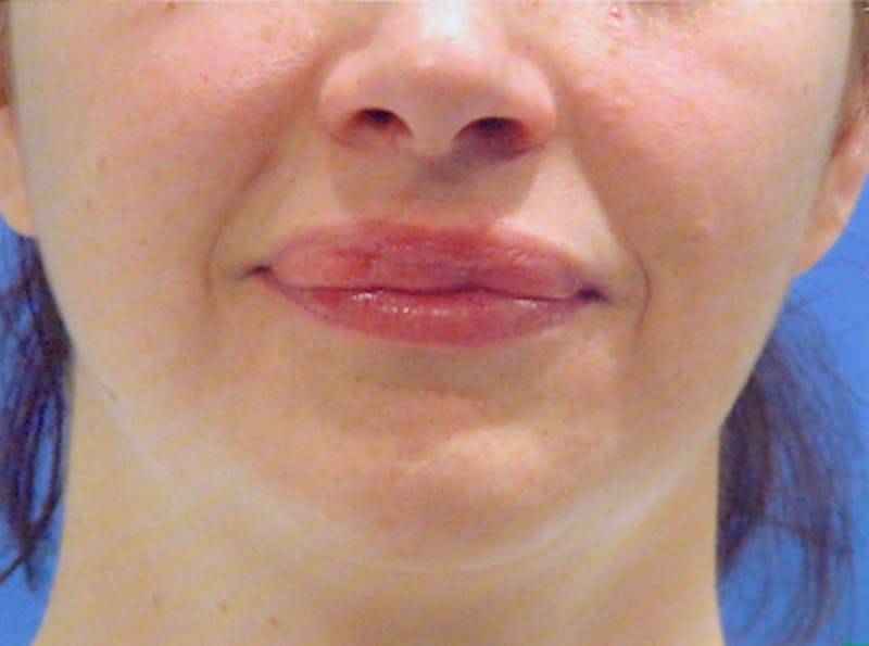Lip Augmentation Before & After Gallery - Patient 252968 - Image 1