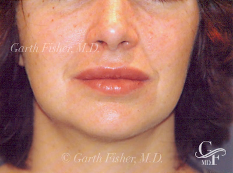 Lip Augmentation Before & After Gallery - Patient 252968 - Image 2