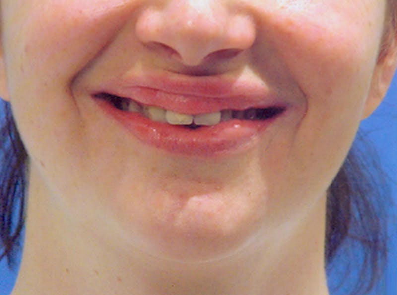 Lip Augmentation Before & After Gallery - Patient 252968 - Image 3